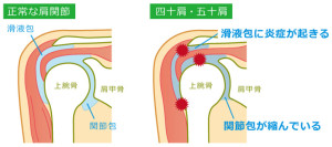 肩峰下滑液包炎