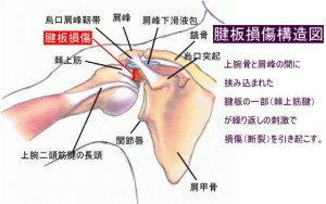 腱板損傷